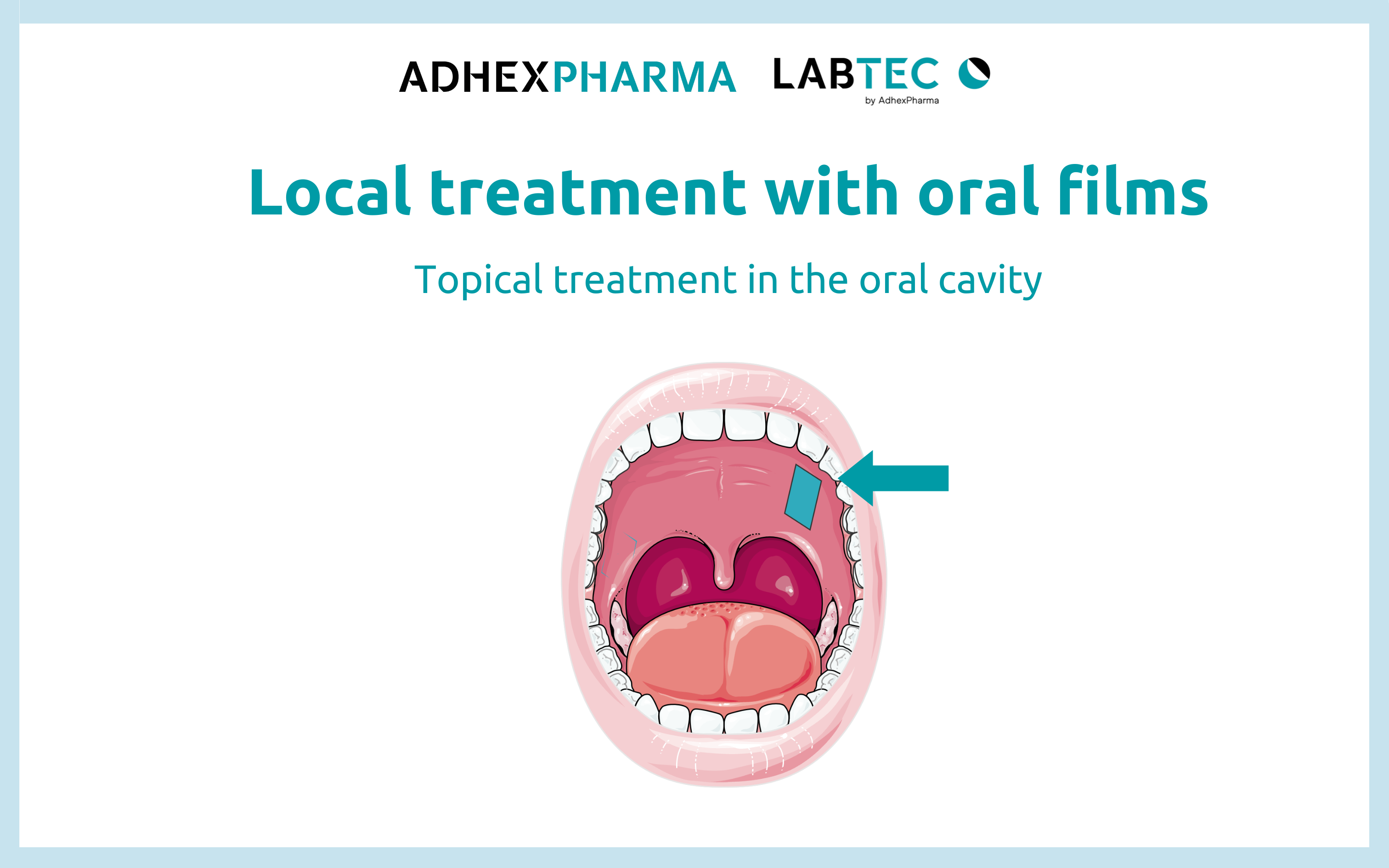 Local treatment with oral films